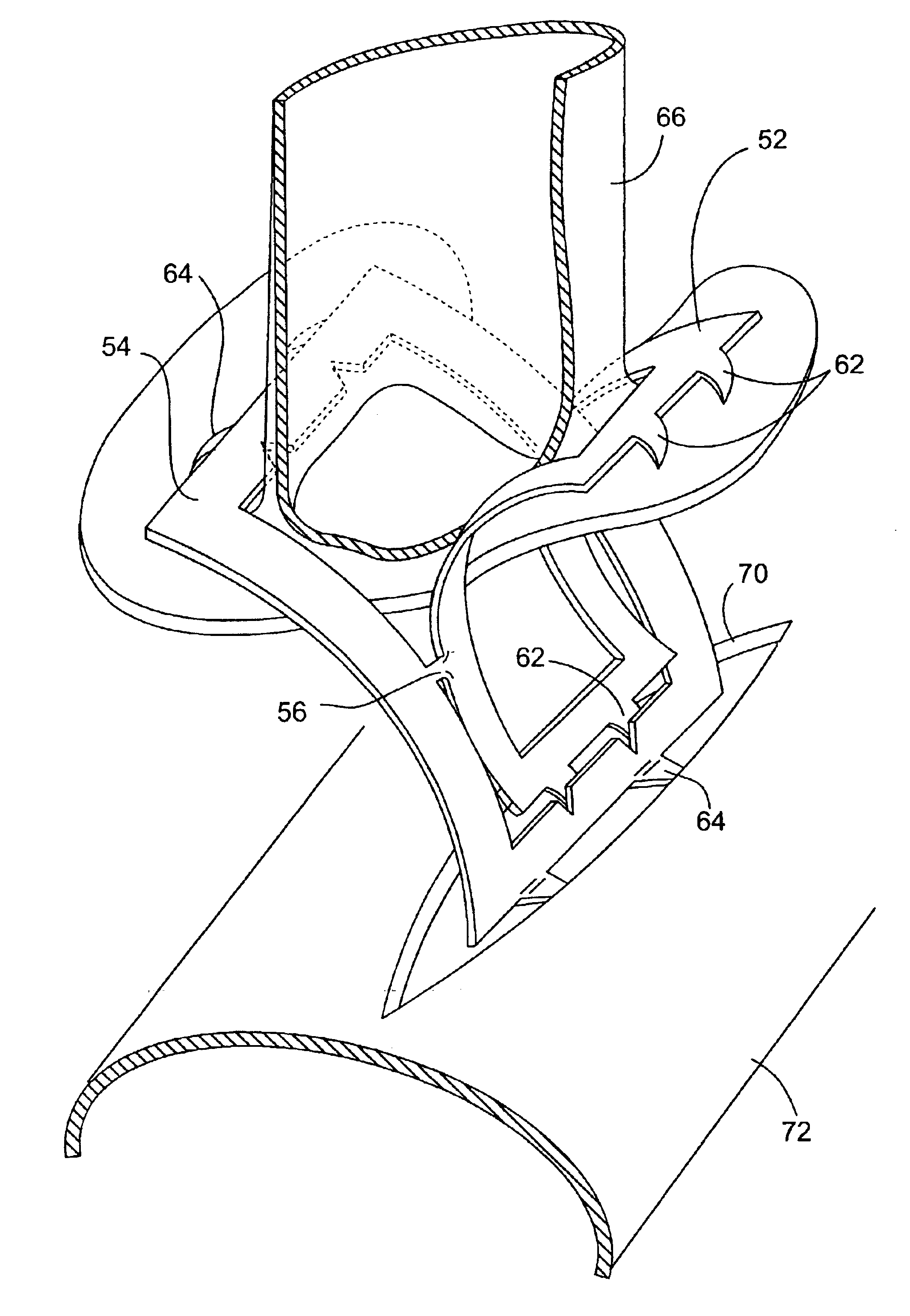 Sutureless closure for connecting a bypass graft to a target vessel