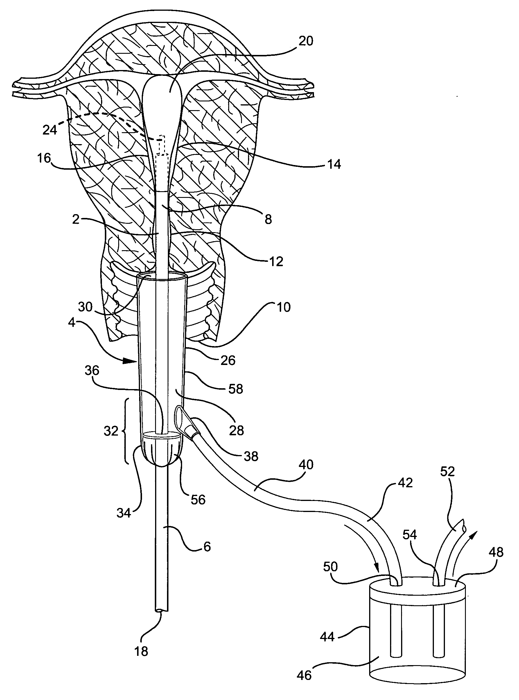 Method and apparatus for vaginal protection from hot fluids during endometrial ablation treatment