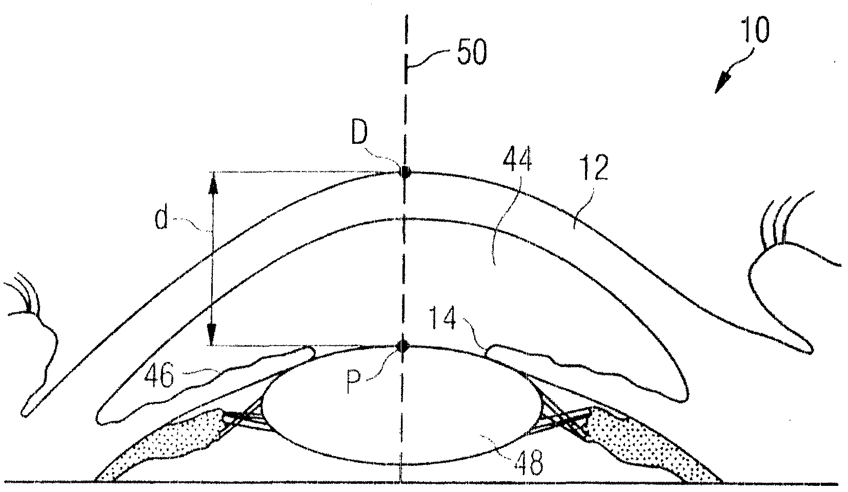 Device, method and control program for ophthalmologic, particularly refractive, laser surgery