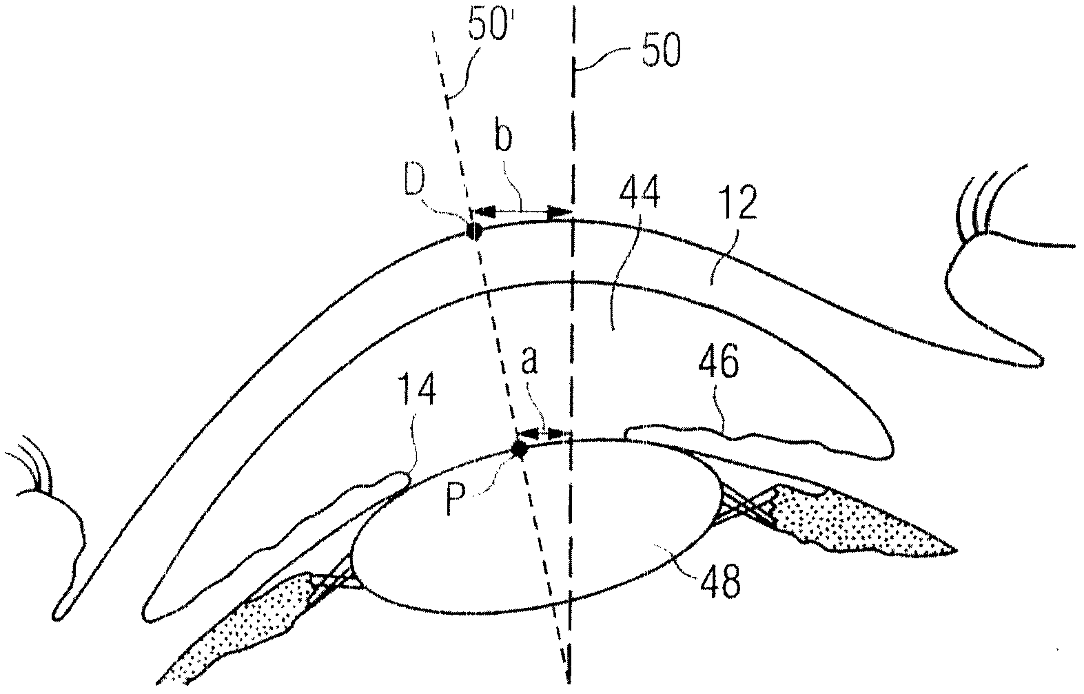 Device, method and control program for ophthalmologic, particularly refractive, laser surgery