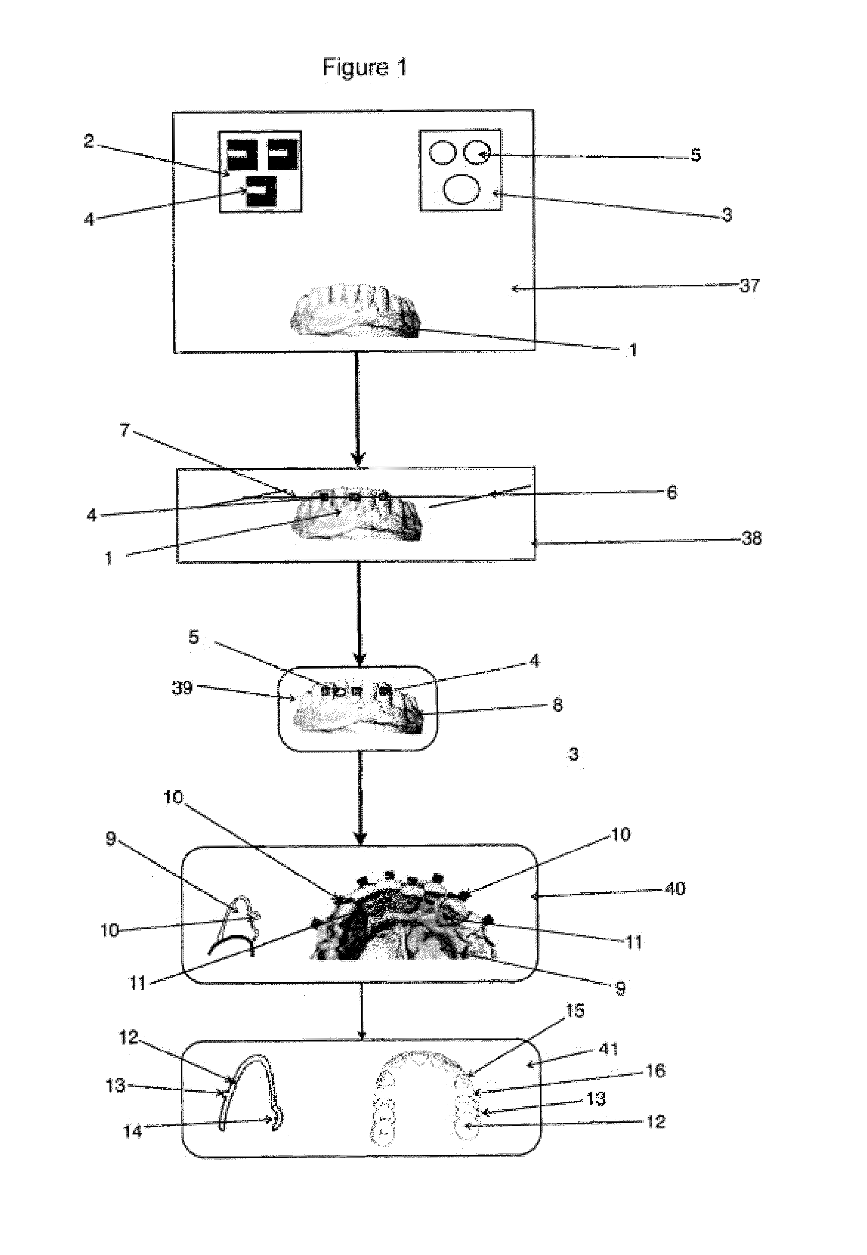 Removable lingual-vestibular dental alignment device and method for the production thereof