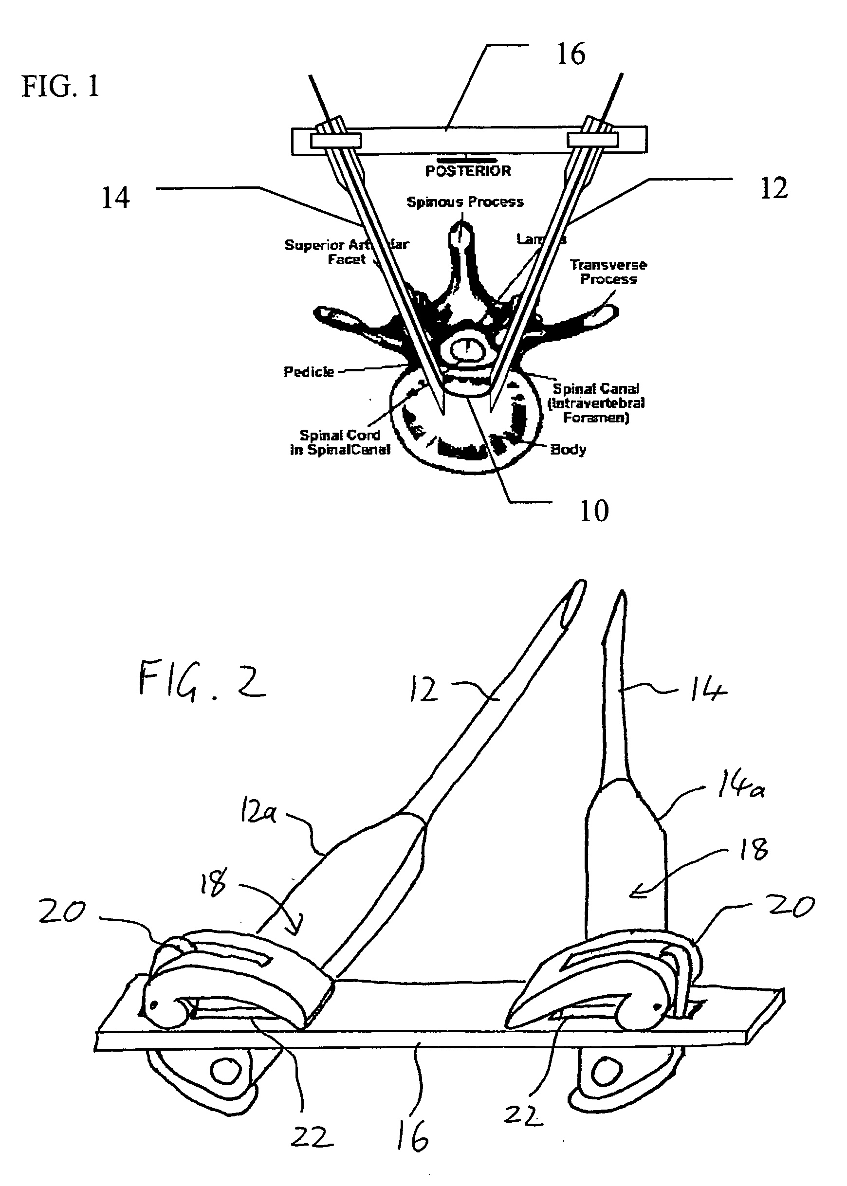 Spinal surgery system and method