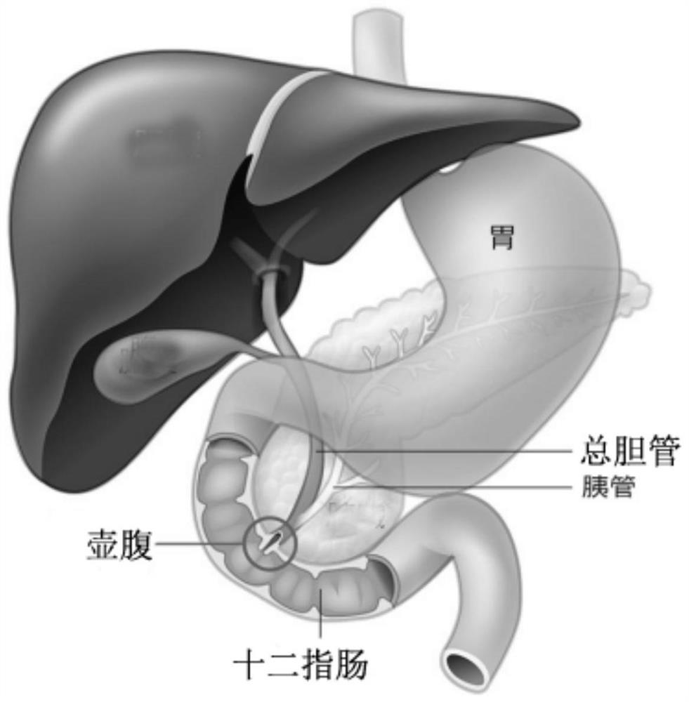 Pancreaticobiliary ampulla carcinoma classification model generation method and image classification method