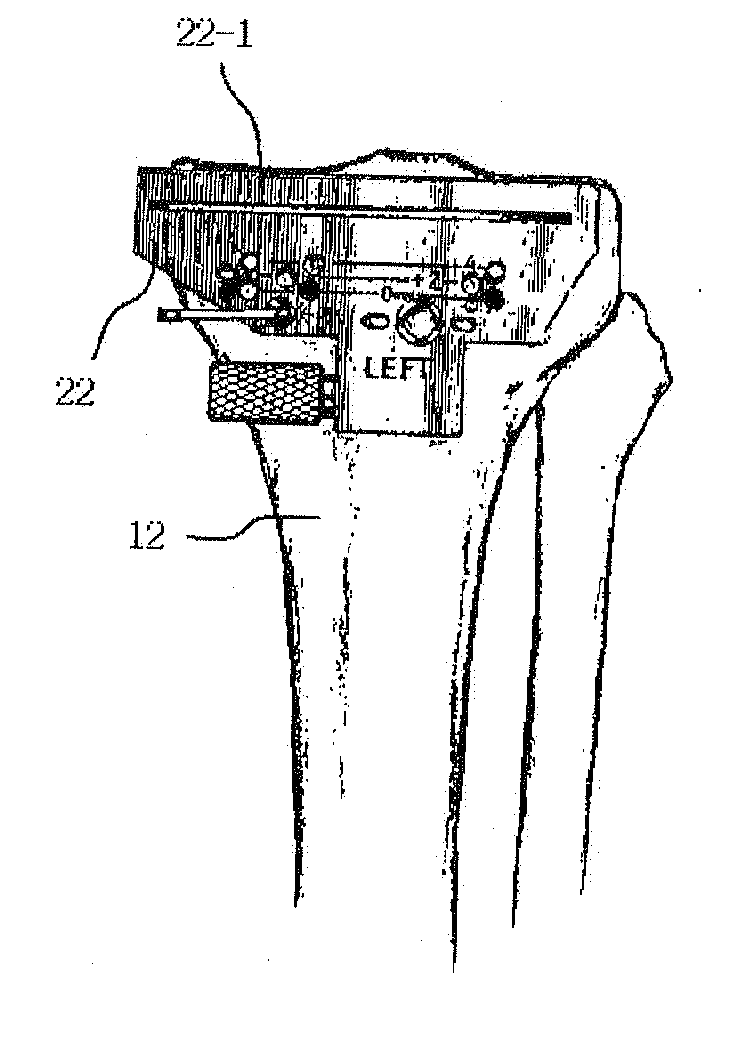 Alignment and connection device of femur cutter and tibia cutter and method of knee arthroplasty using the same