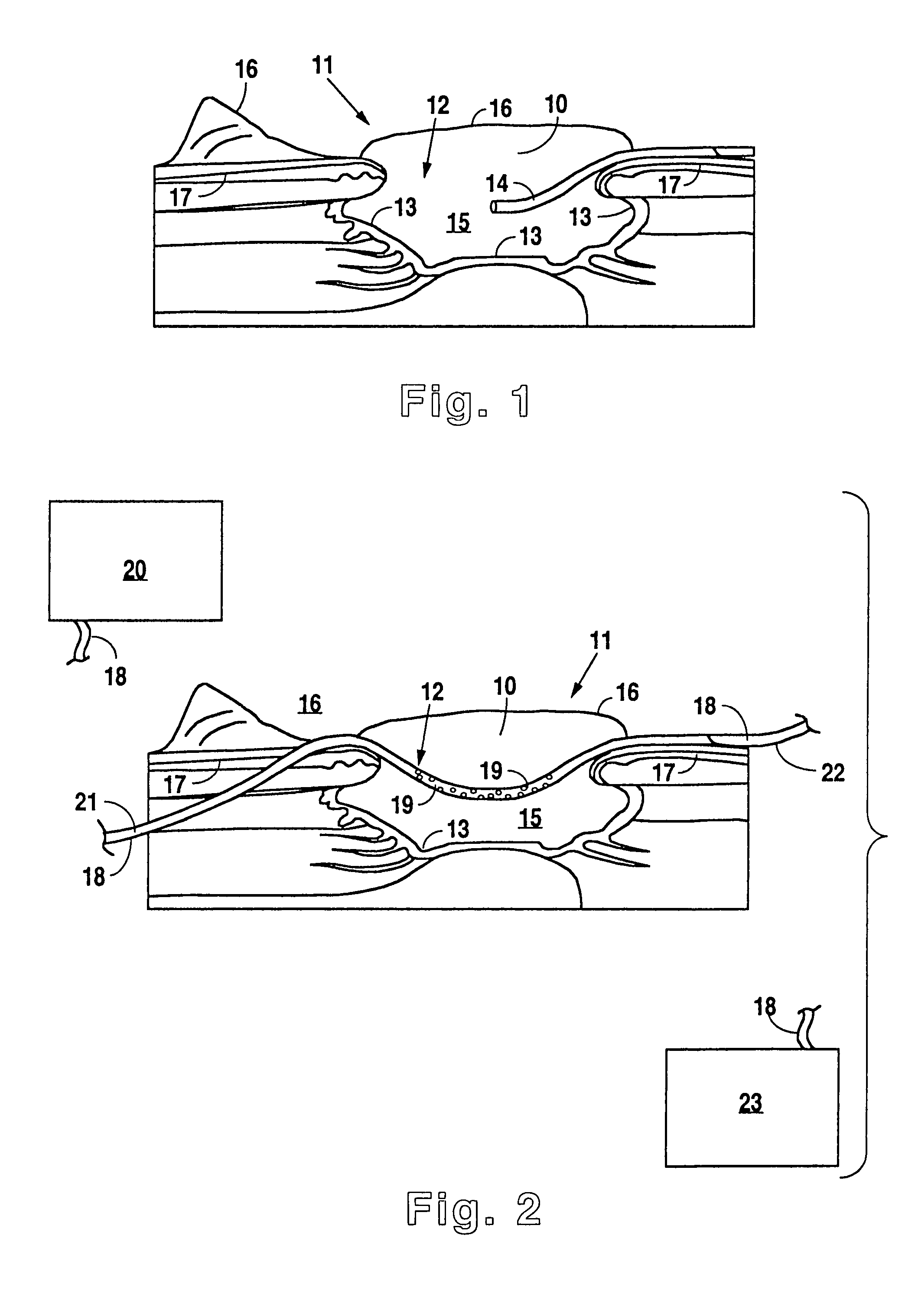 Method and apparatus for wound treatment