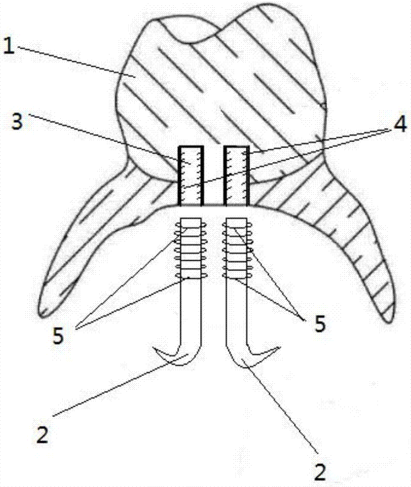 Zirconium dioxide all-ceramic tooth through 3D printing and preparation method thereof