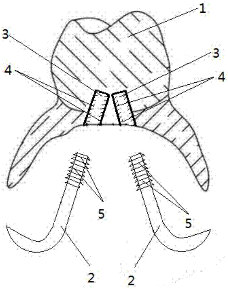 Zirconium dioxide all-ceramic tooth through 3D printing and preparation method thereof