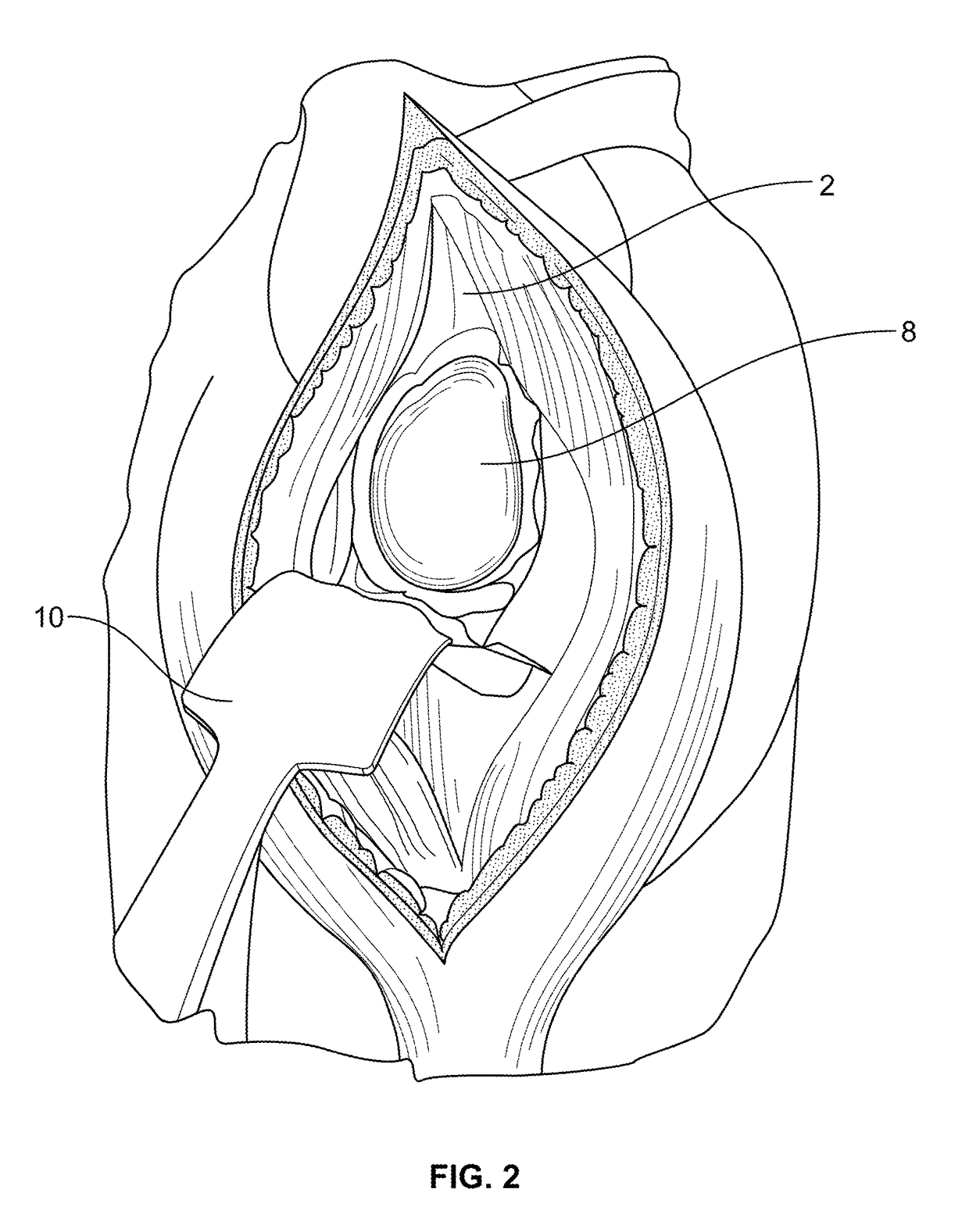 Shape-fit glenoid reaming systems and methods