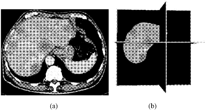 Liver tumor region segmentation method based on watershed transform and classification through support vector machine