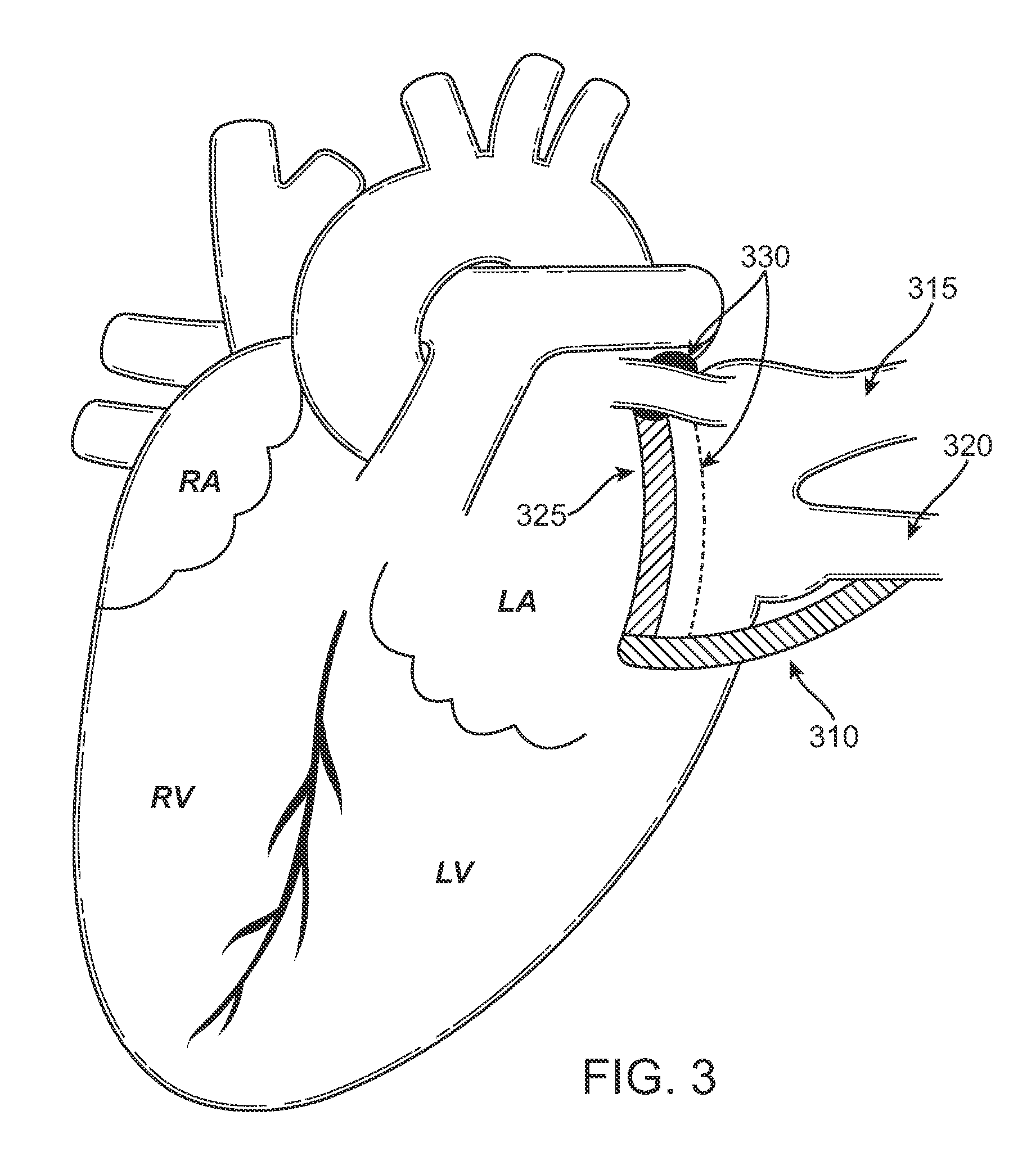 Methods of treating a cardiac arrhythmia by thoracoscopic production of a Cox maze III lesion set