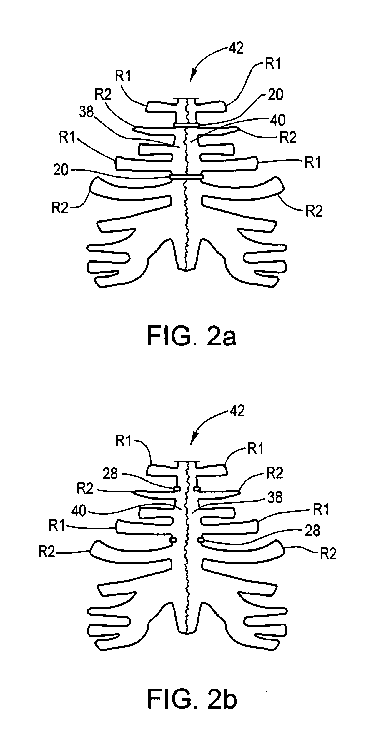 Shape-Transforming Implant Device