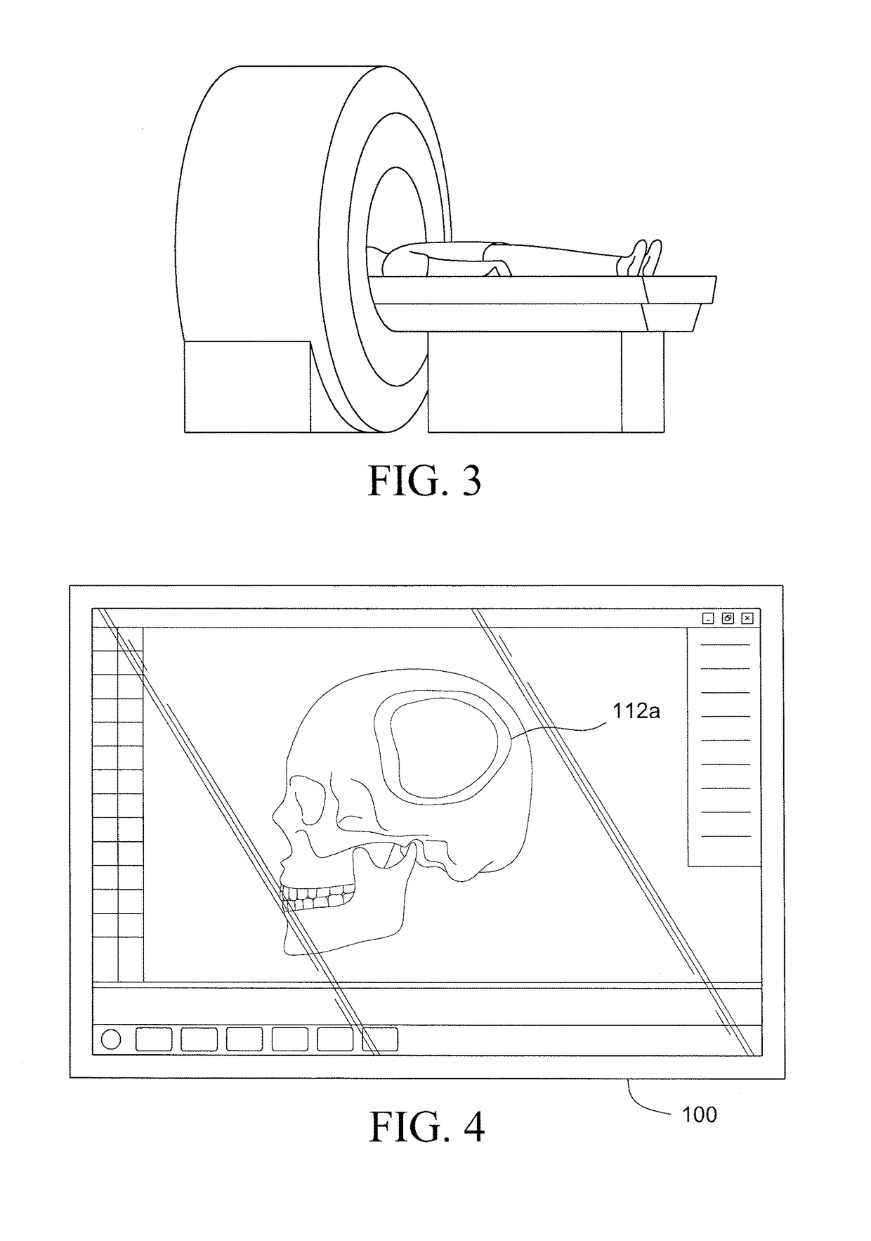 Method for manufacturing a low-profile intercranial device and the low-profile intercranial device manufactured thereby