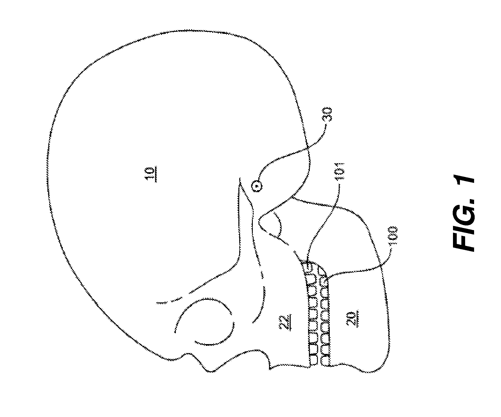 Method for producing teeth surface from x-ray scan of a negative impression