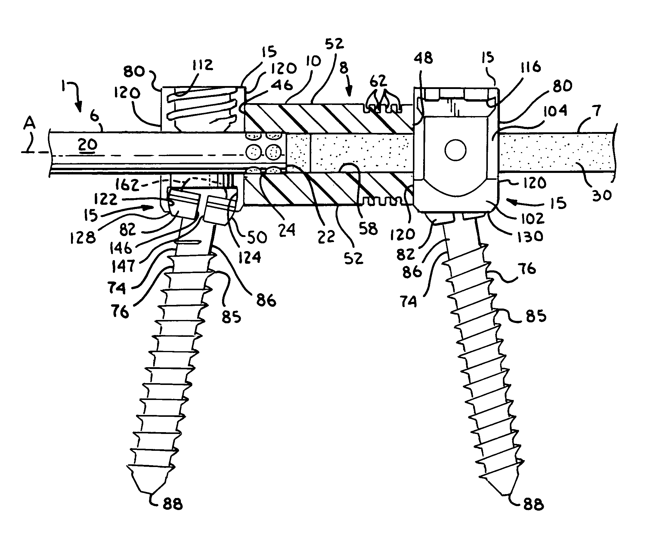 Dynamic stabilization member with molded connection