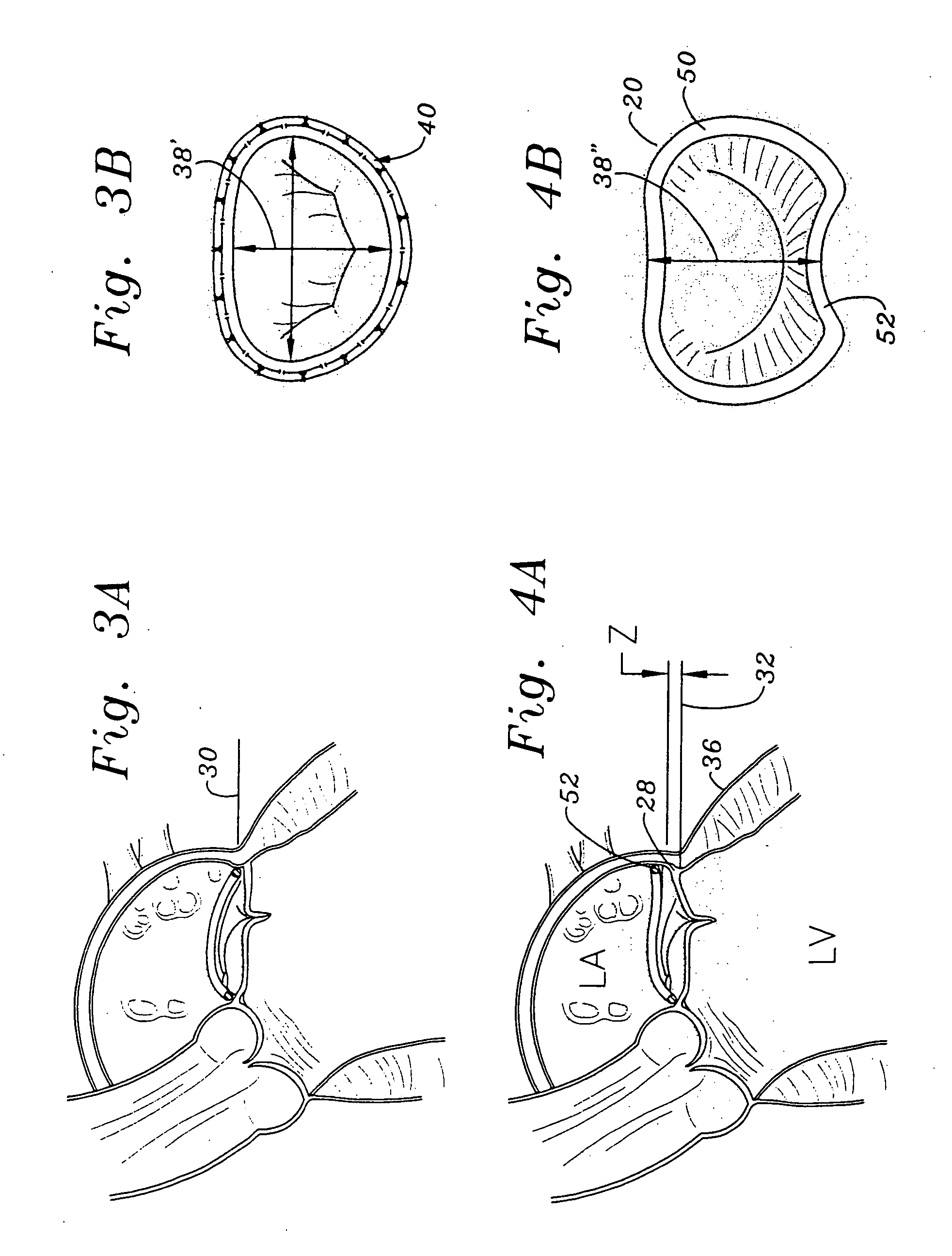 Methods of implanting a mitral valve annuloplasty ring to correct mitral regurgitation