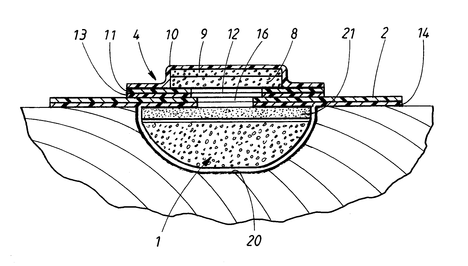 Device for treatment of wounds with reduced pressure