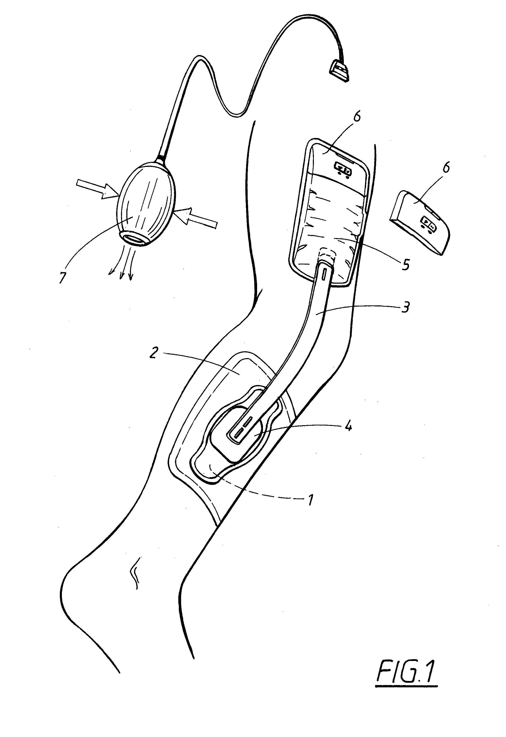 Device for treatment of wounds with reduced pressure