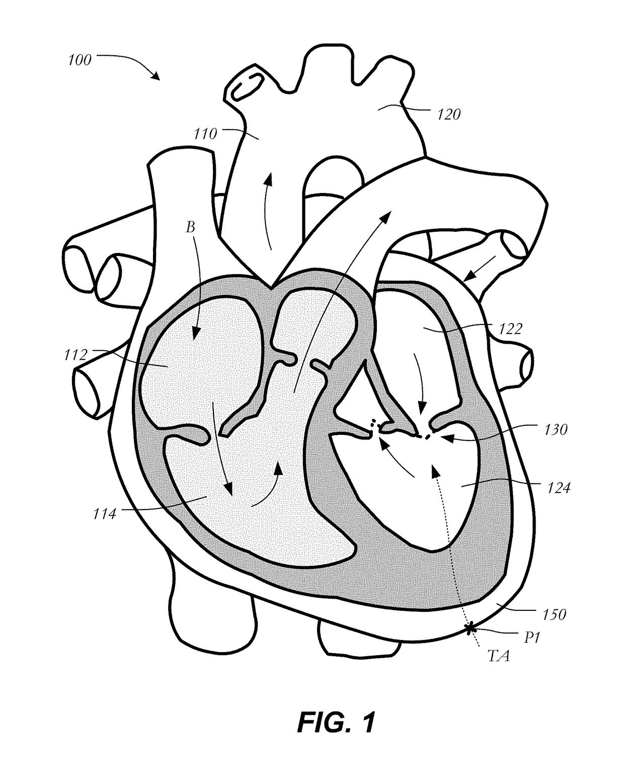 Mitral heart valve replacement