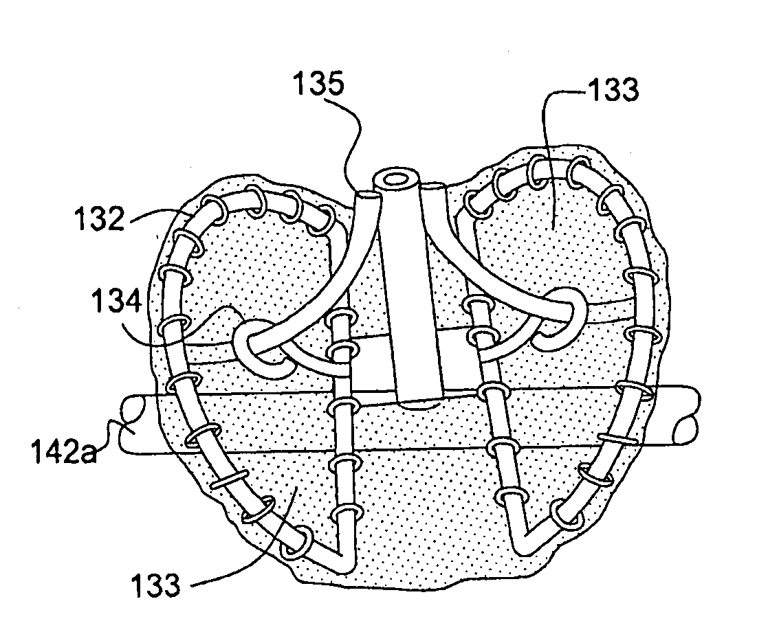 Percutaneous valve prosthesis and system and method for implanting same