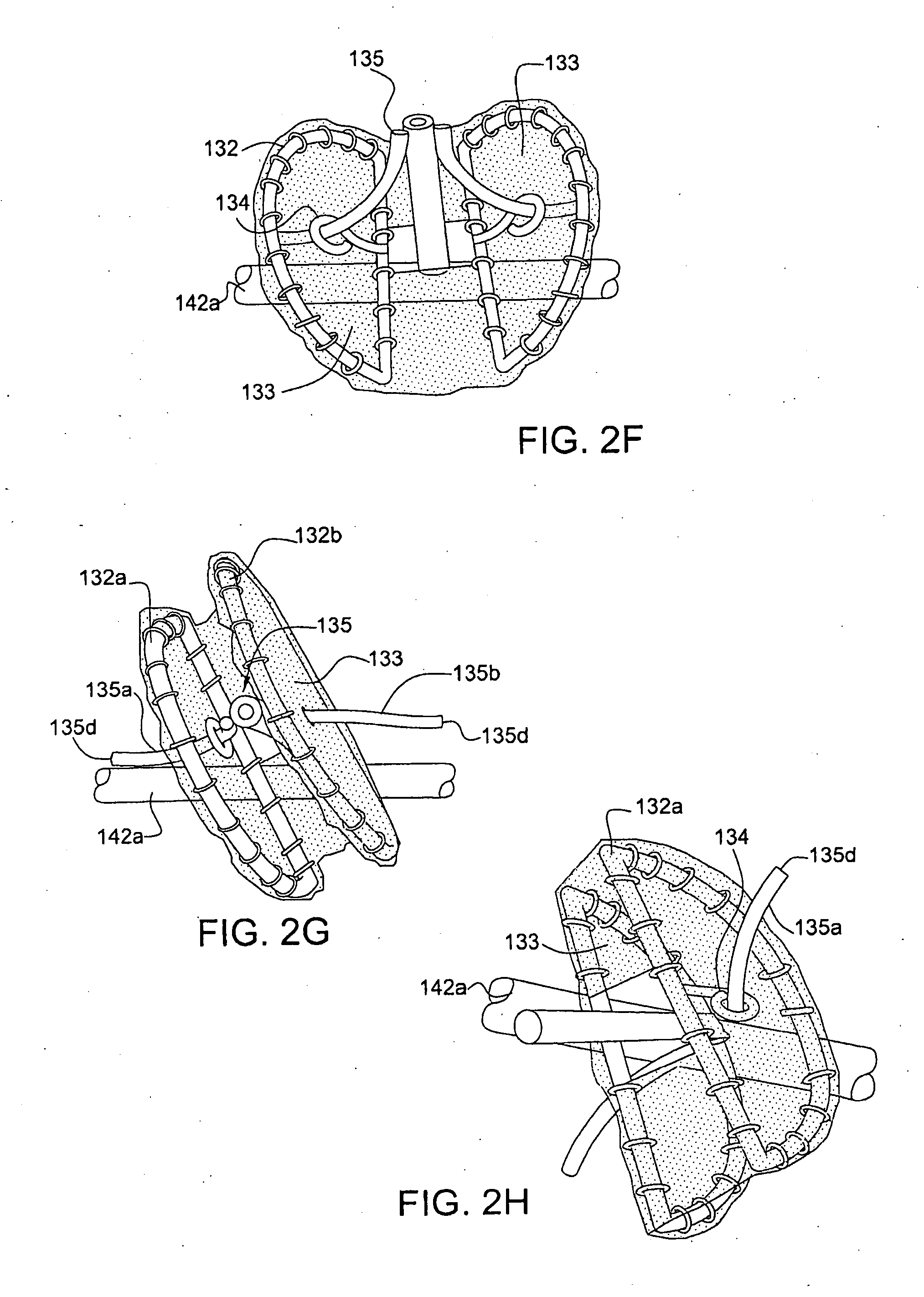 Percutaneous valve prosthesis and system and method for implanting same