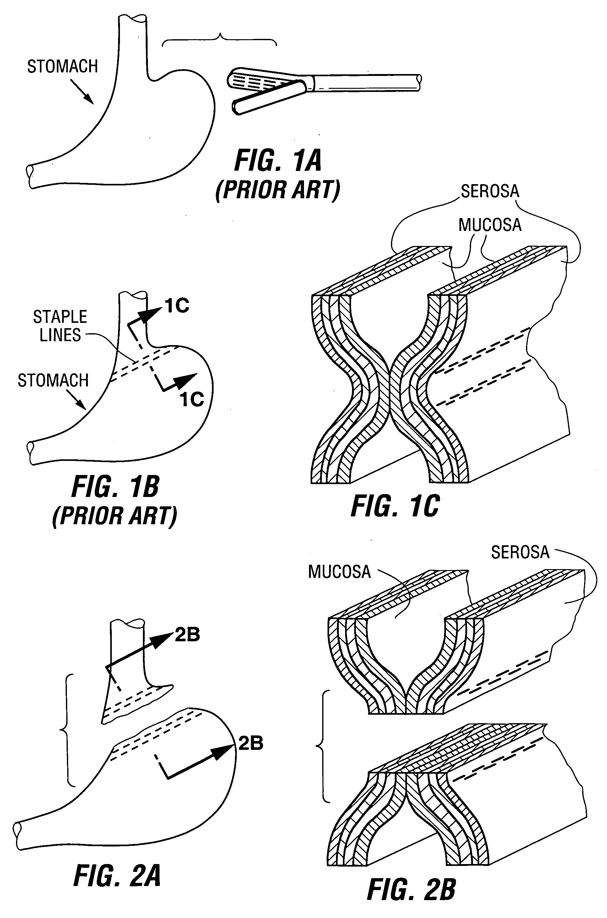 Devices and methods for stomach partitioning