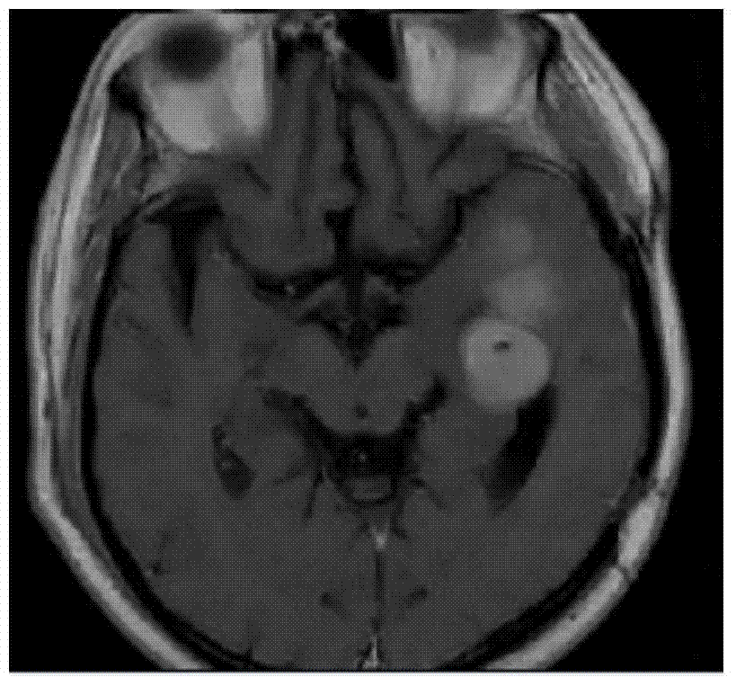 MRI automatic image segmentation method based on lesion volume measurement