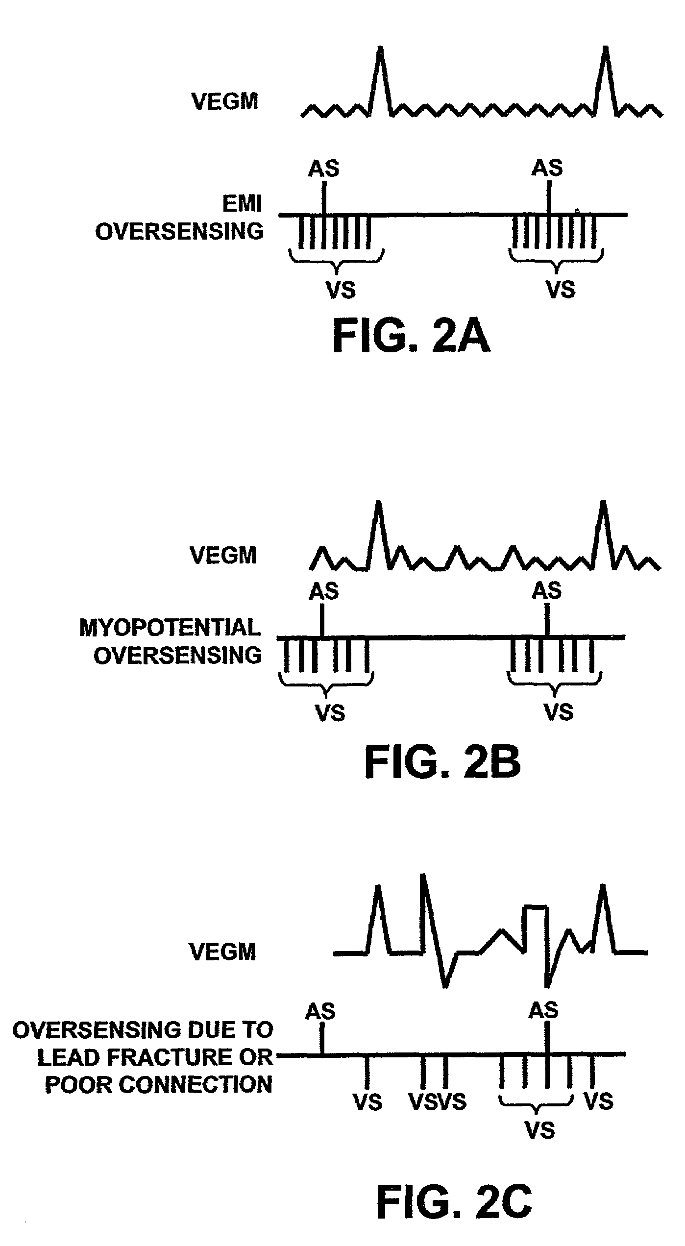 Method and apparatus for identifying cardiac and non-cardiac oversensing using intracardiac electrograms