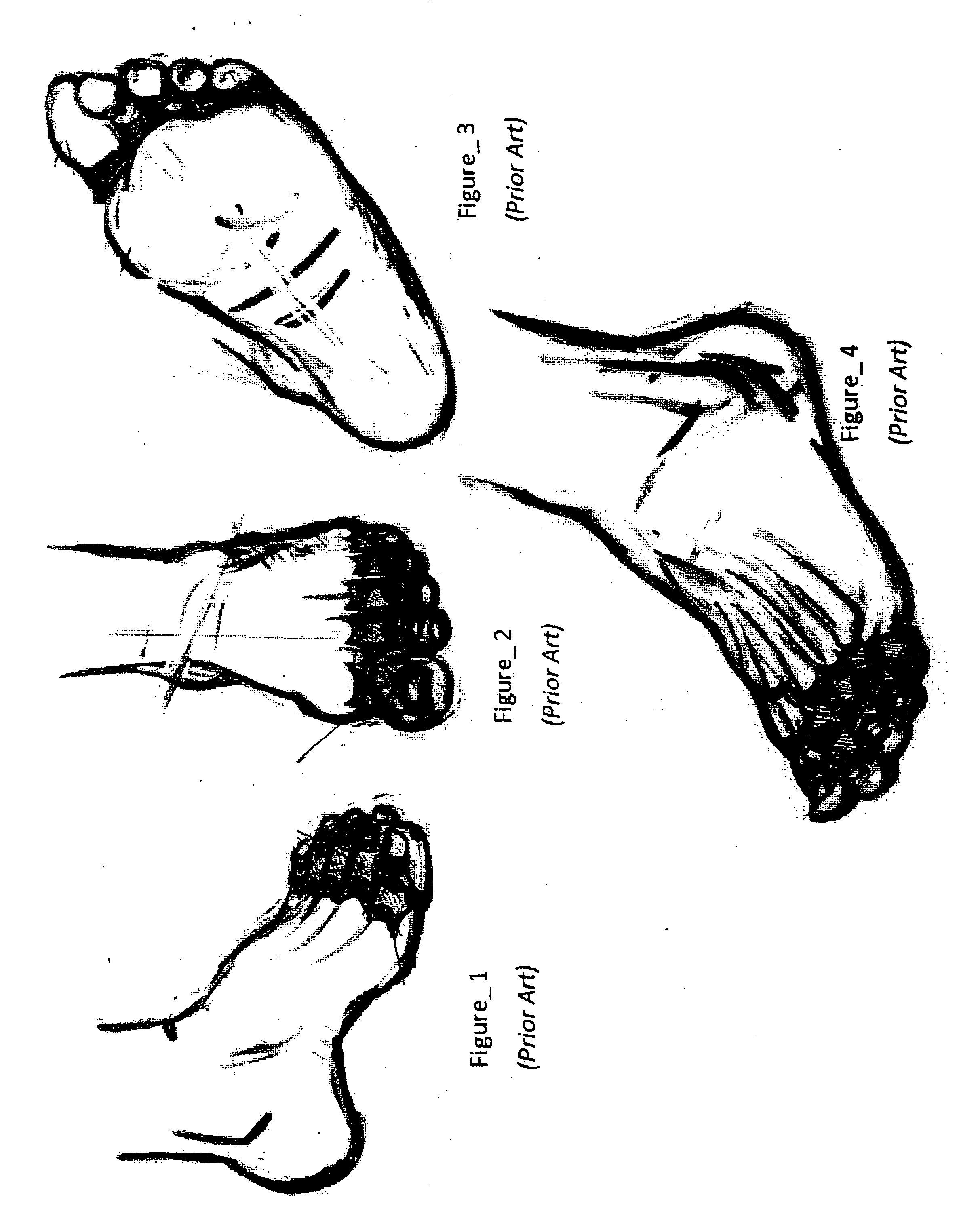 Toe Shield Glove (TSG)