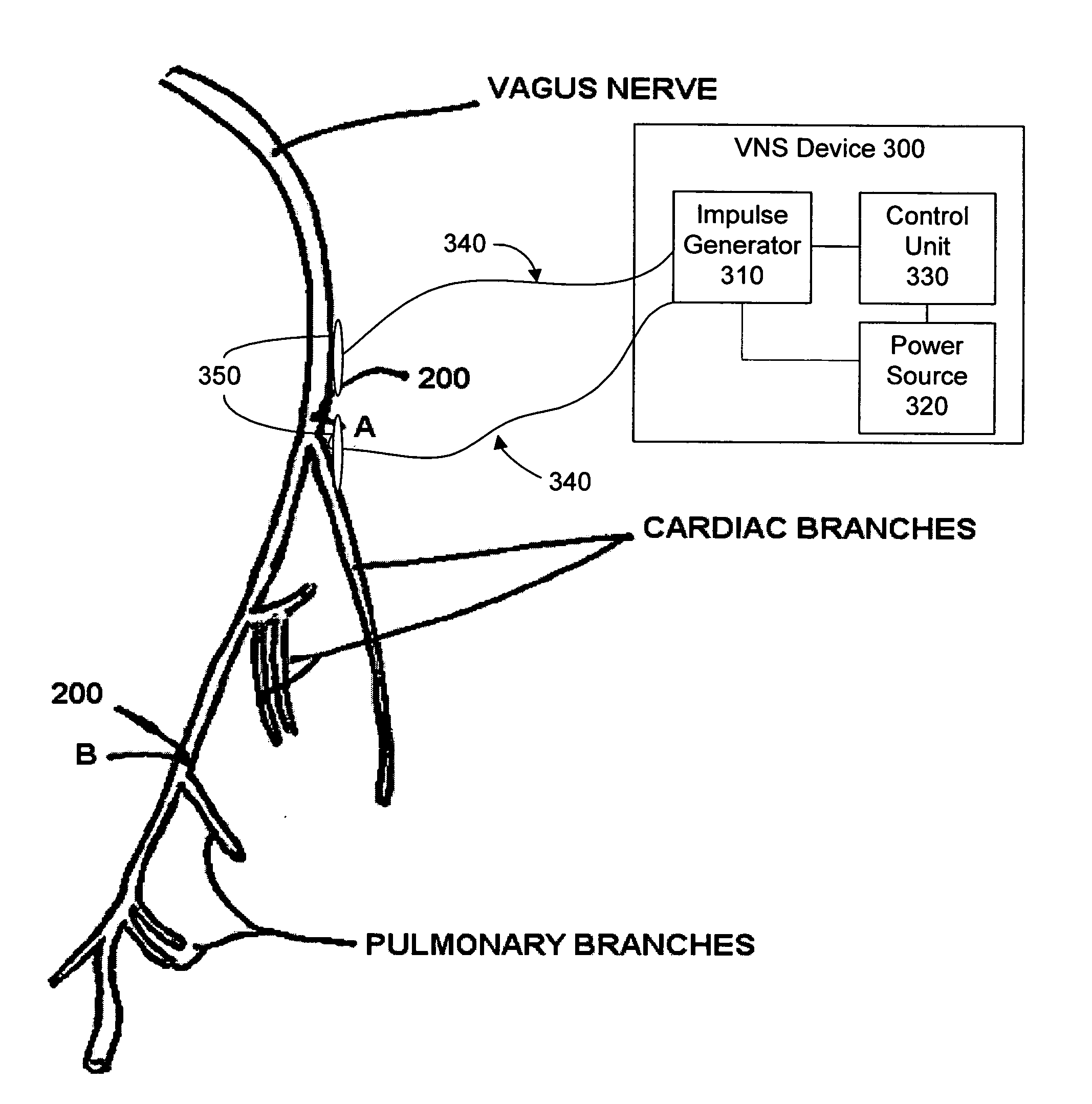 Electrical stimulation treatment of bronchial constriction