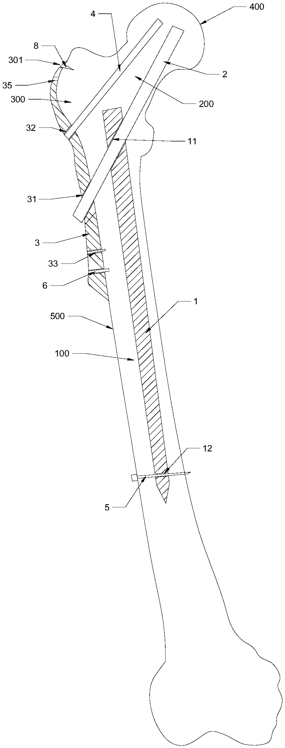 Internal fixation device for treating complex intertrochanteric fracture and application method thereof