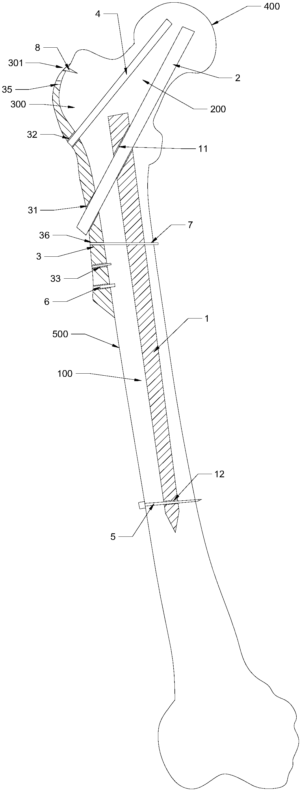 Internal fixation device for treating complex intertrochanteric fracture and application method thereof