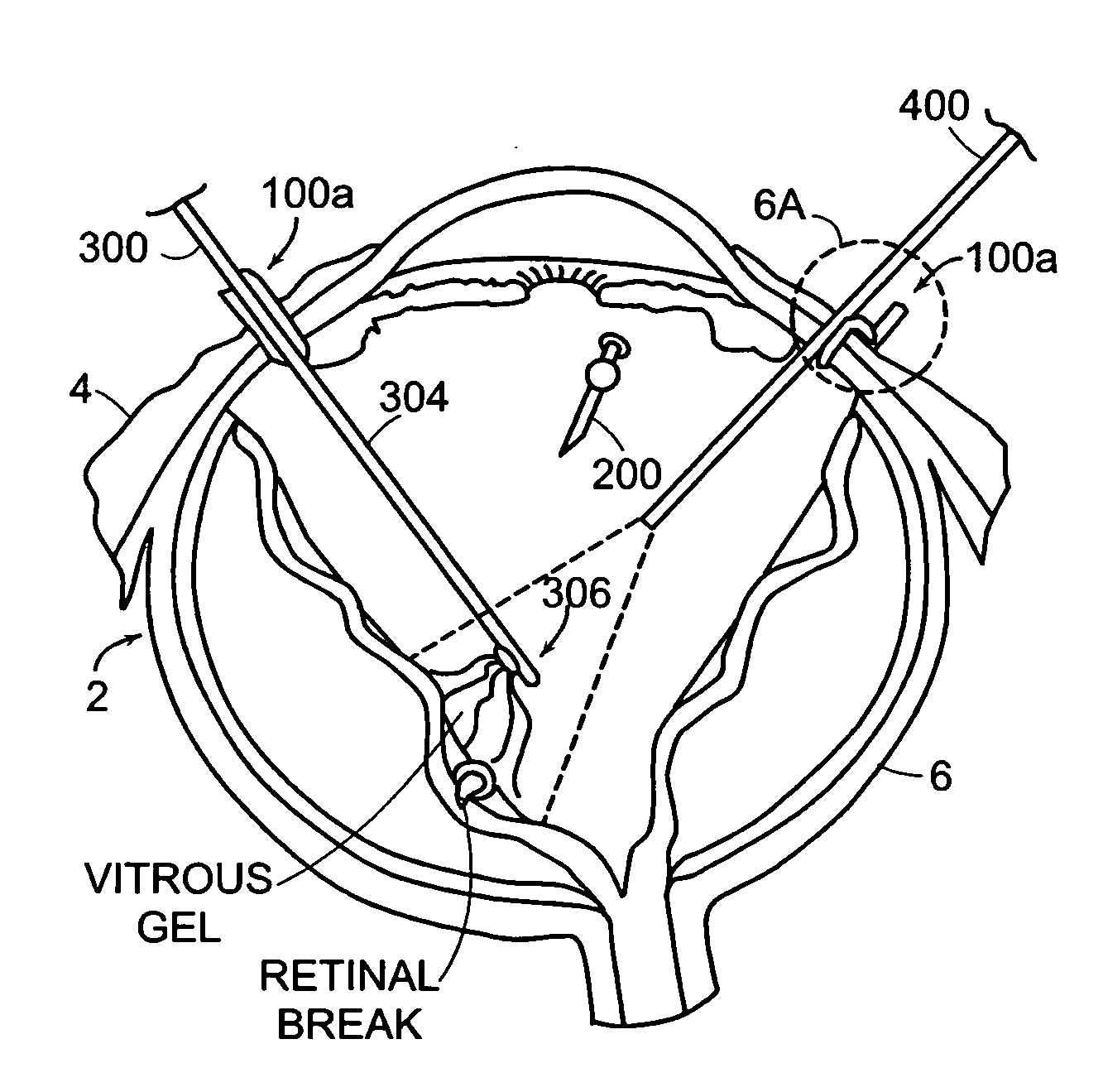 Sutureless occular surgical methods and instruments for use in such methods