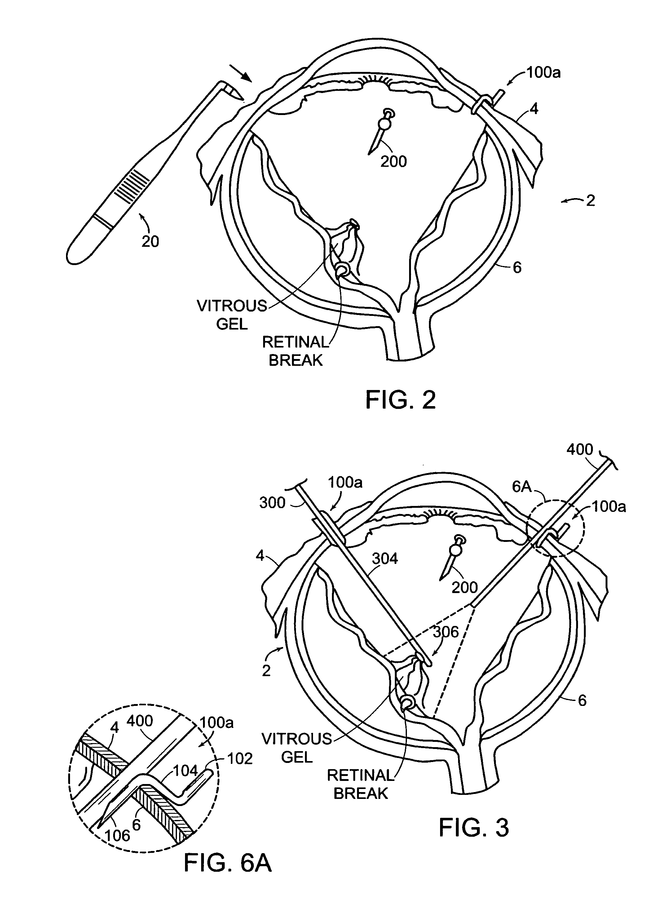 Sutureless occular surgical methods and instruments for use in such methods