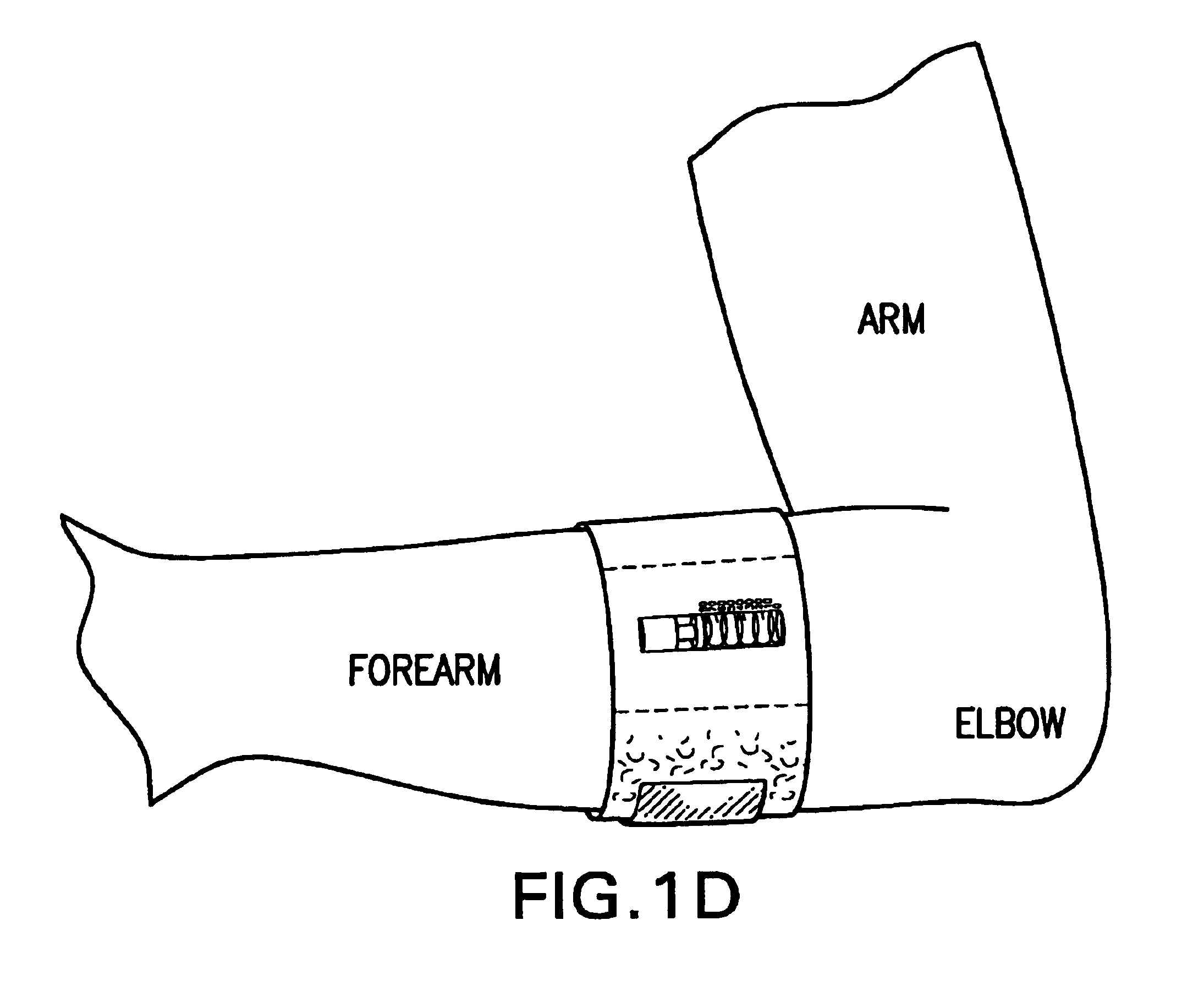 Forearm support band with direct pressure monitoring