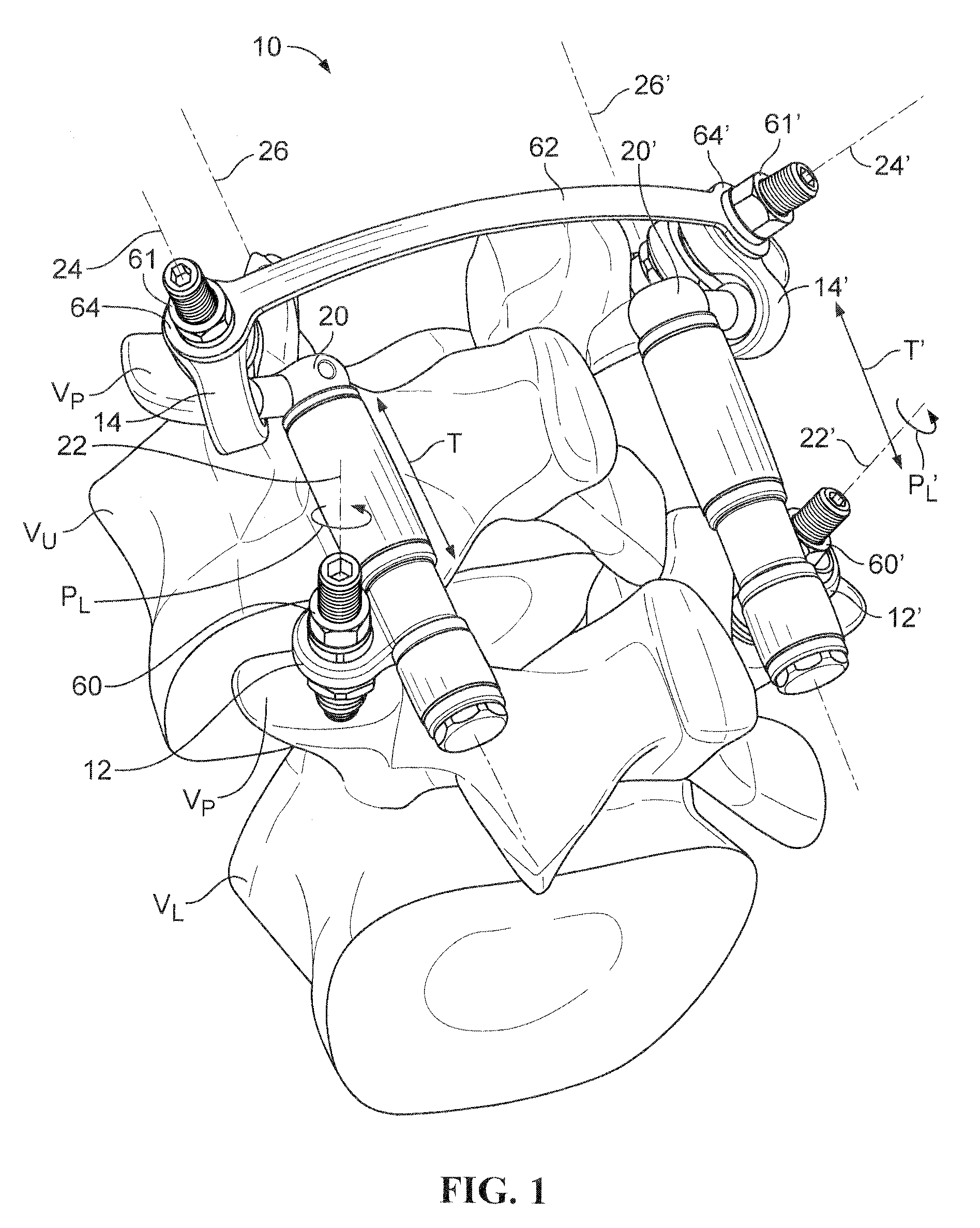 Posterior lumbar joint prosthesis