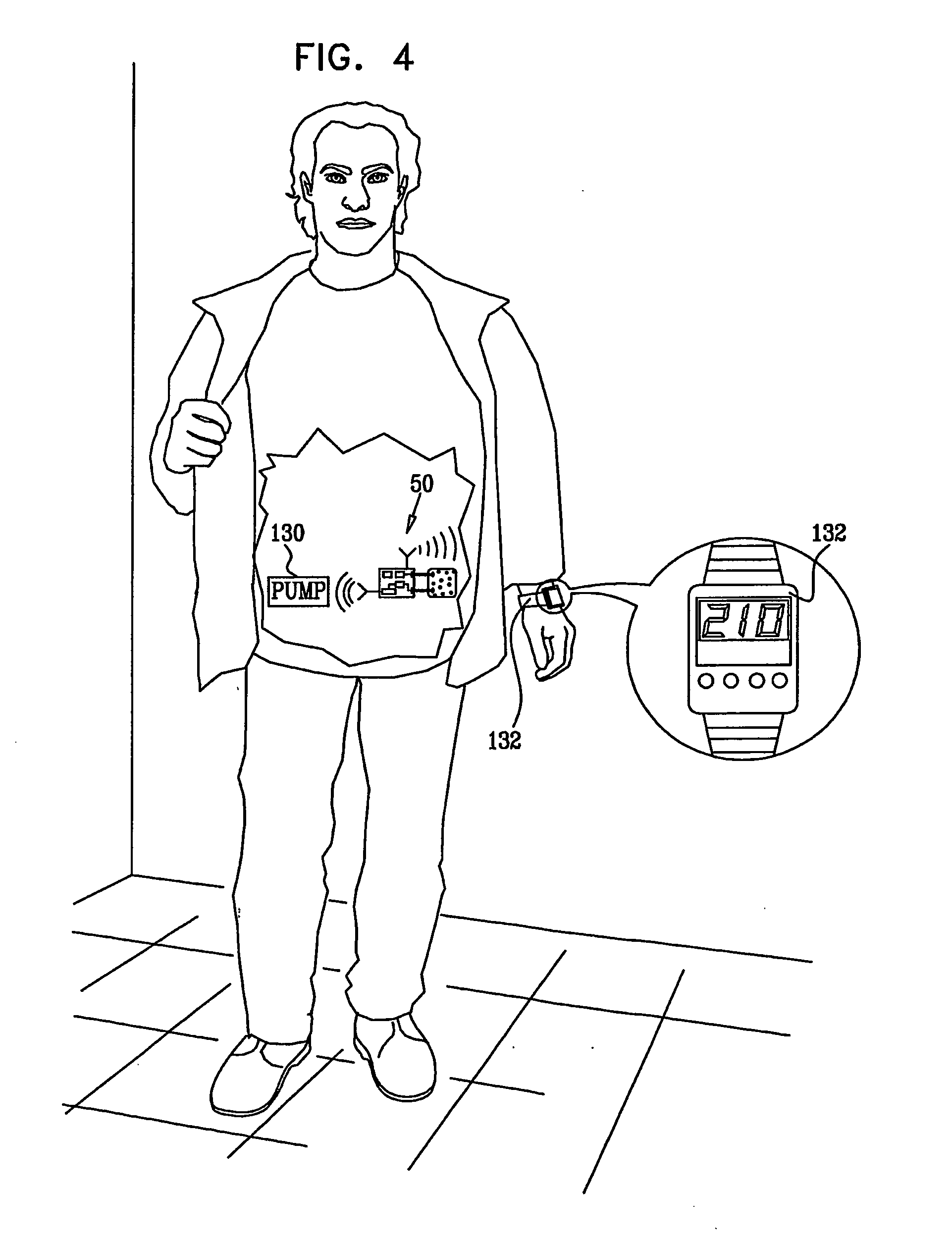 Implantable Sensor