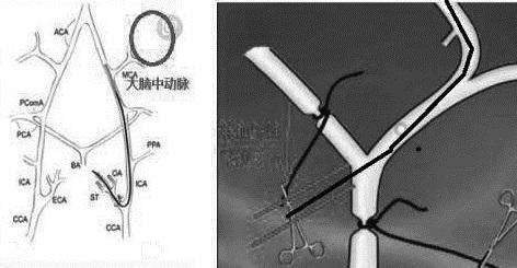 A microsphere catheter thread plug device for rat mcao model