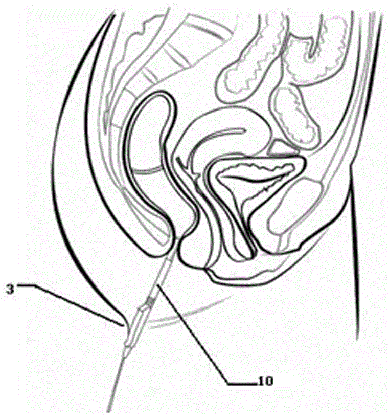 Method for detecting pelvic organs by ultrasound intracavitary probe after filling of transrectal enteric cavity