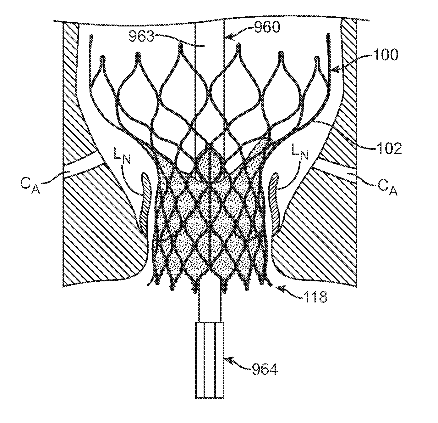 Methods and devices for repairing and/or preventing paravalvular leakage post-implantation of a valve prosthesis