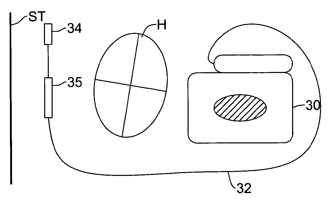 Multiple electrode vectors for implantable cardiac treatment devices