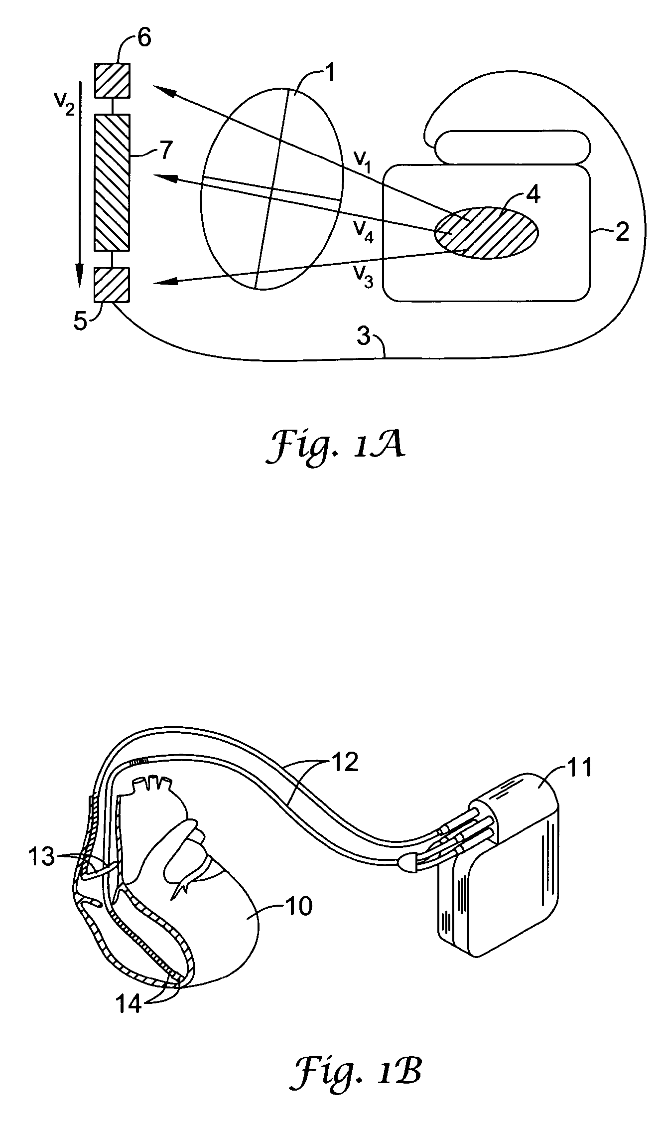 Multiple electrode vectors for implantable cardiac treatment devices