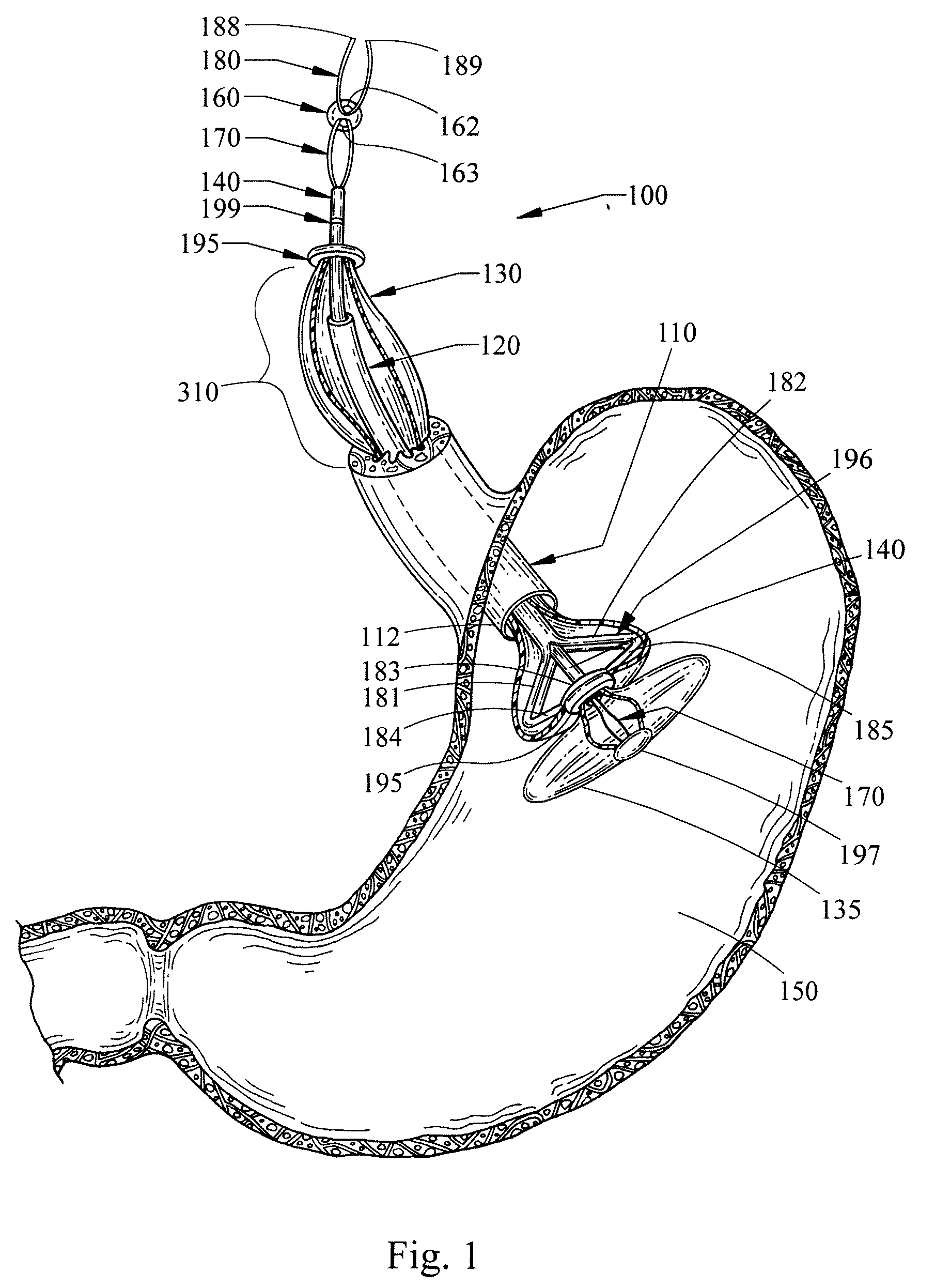 Delivery system and method of delivery for treating obesity