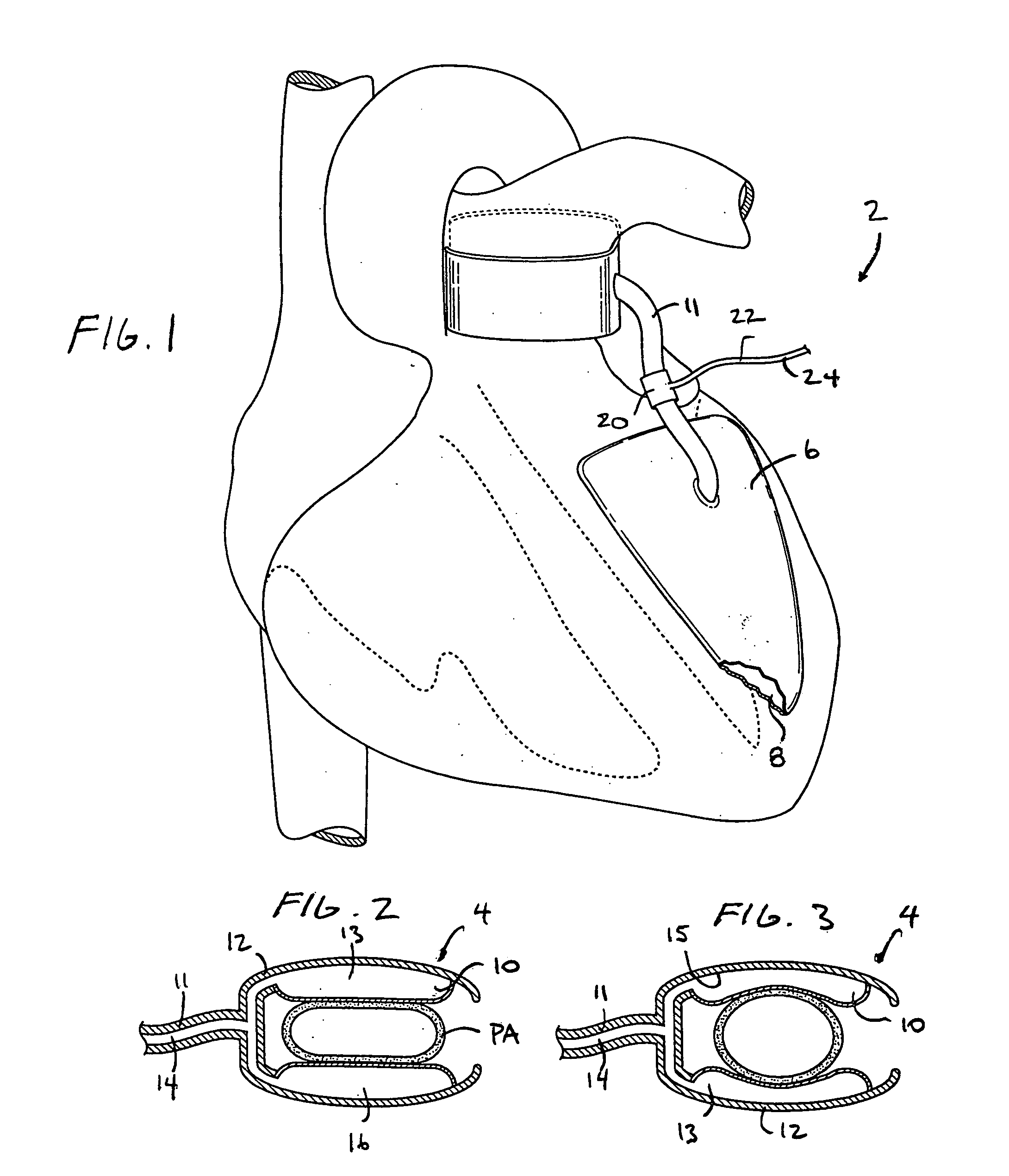 Devices and methods for absorbing, transferring, and delivering heart energy