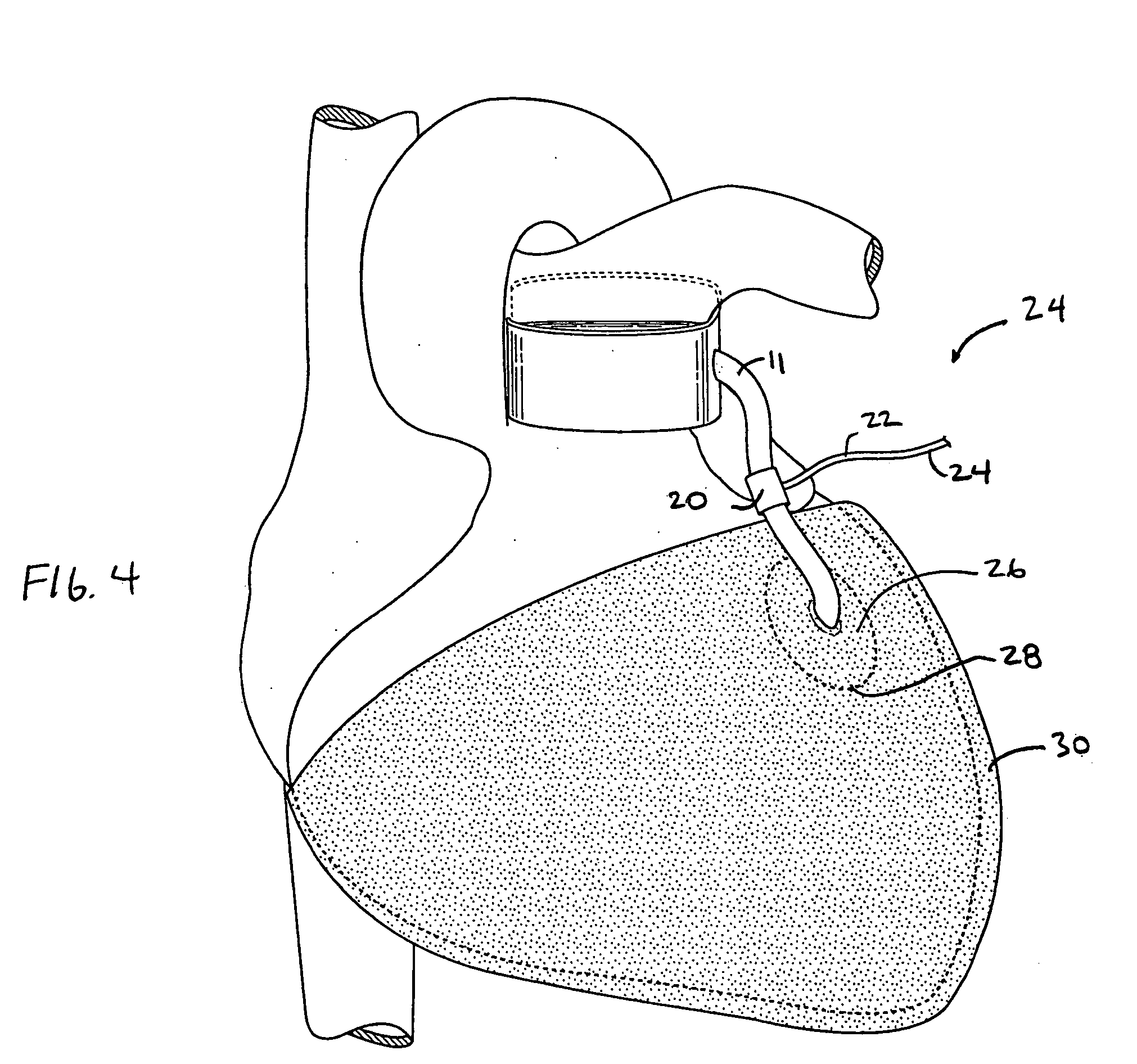 Devices and methods for absorbing, transferring, and delivering heart energy