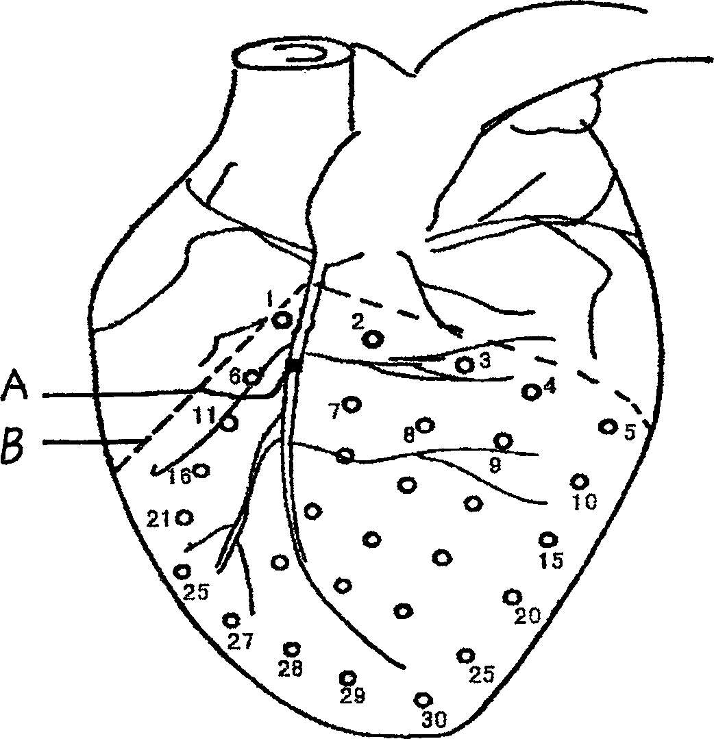 Compound medication of valerian for treating coronary heart disease, and preparation method