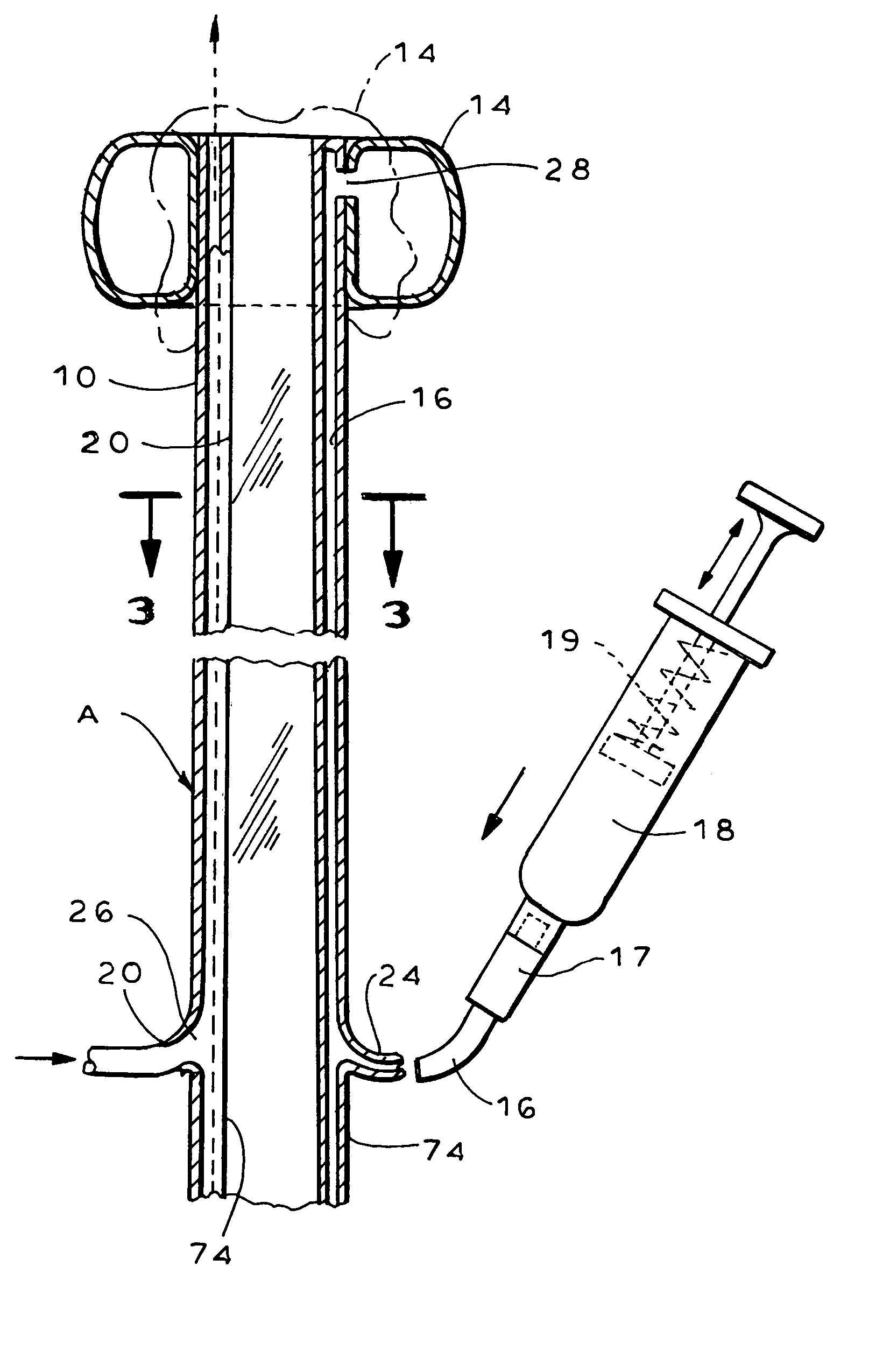 Fecal management appliance and method and apparatus for introducing same