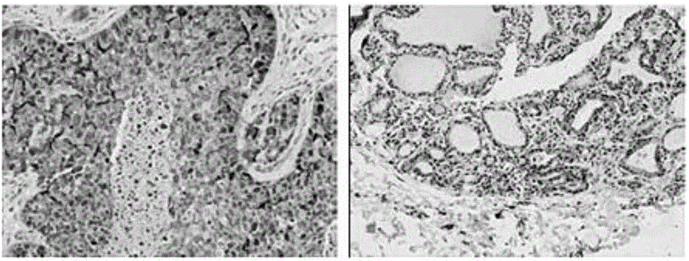 Application of SPAG6 gene serving as diagnosis and treatment marker for tumor ovarii