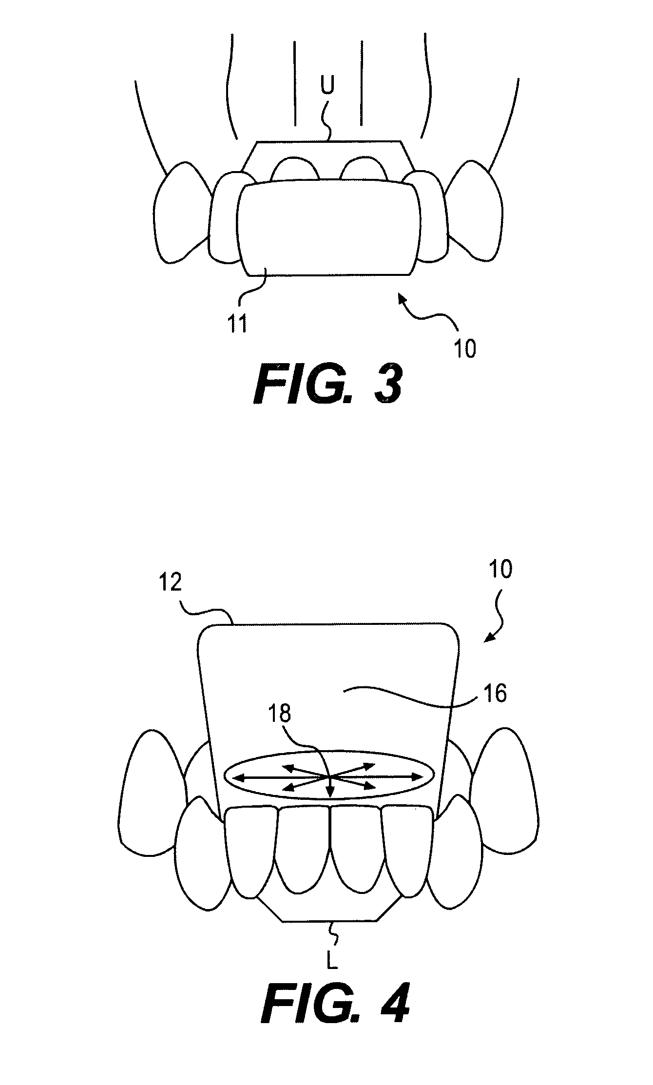 Intra-oral device