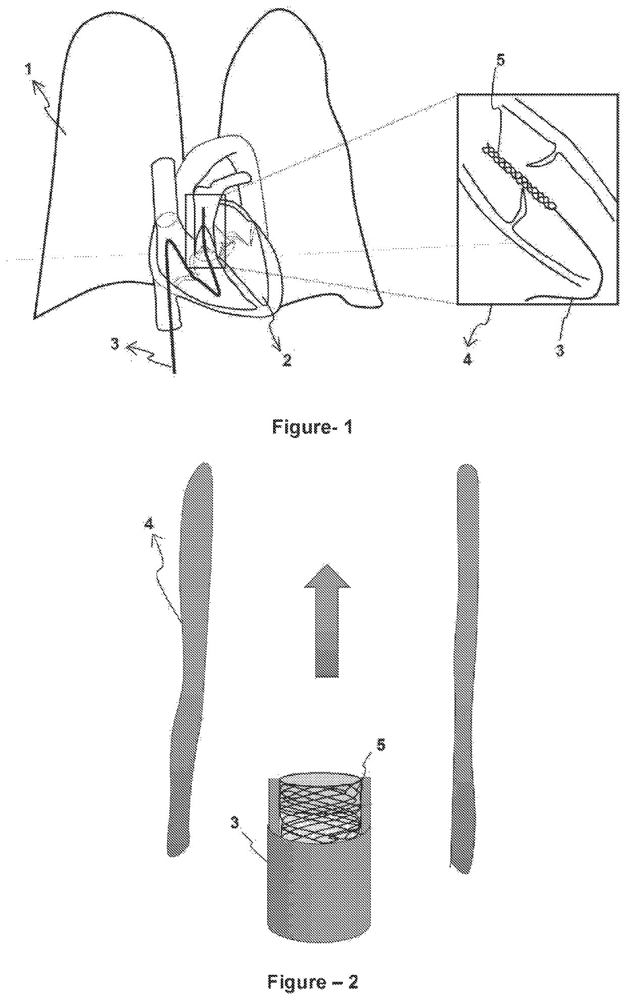 Medical device being inserted intravascularly and providing protection against pulmonary hypertension risk in treatment of patients with heart defect