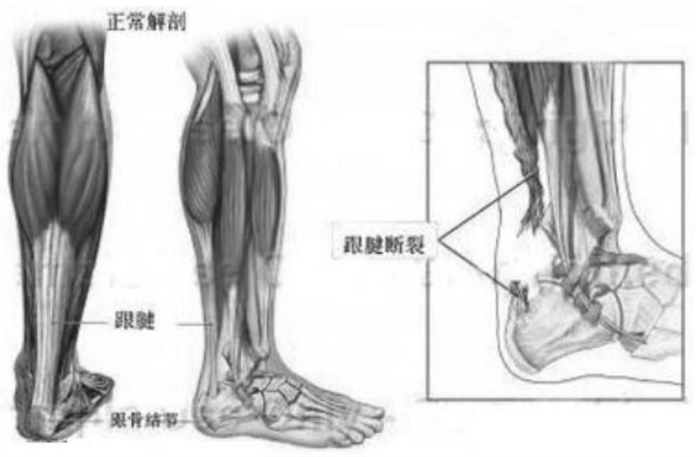 Portable athlete Achilles tendon massage platform and method